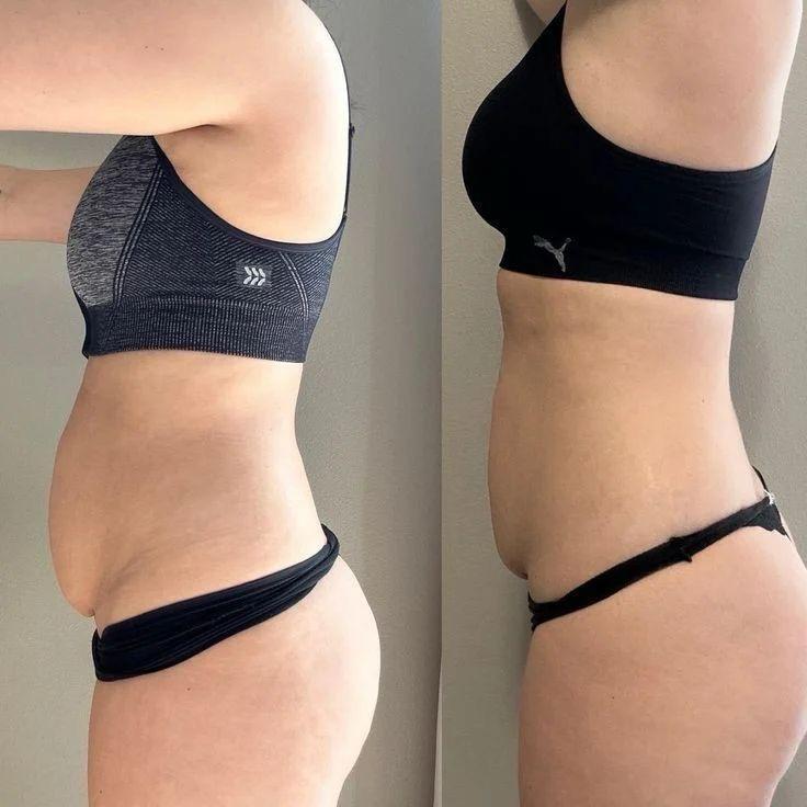 Antes e depois de tratamento corporal no abdômen em perfil