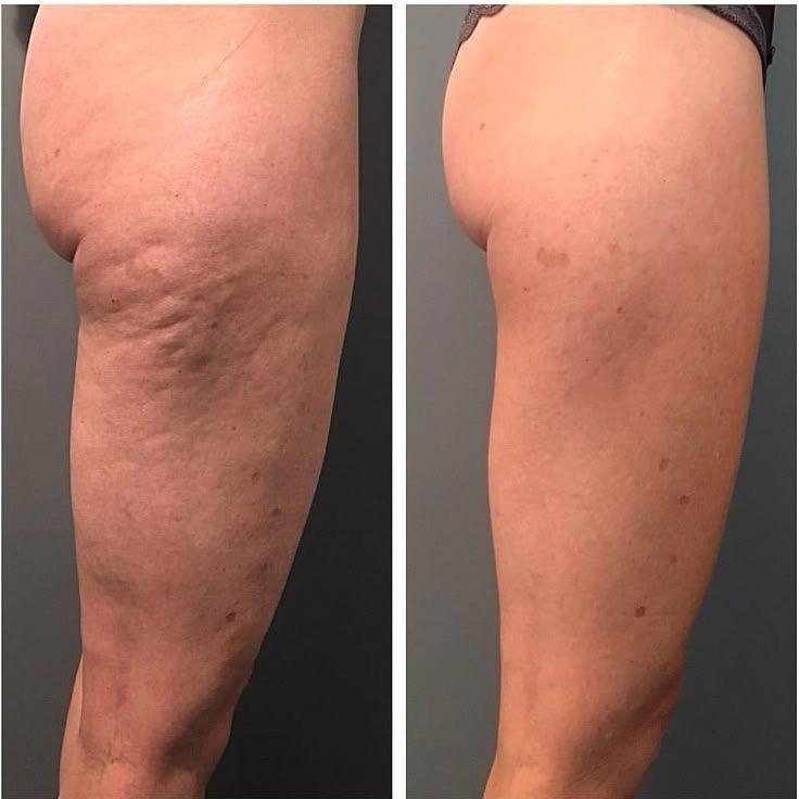 Antes e depois de tratamento corporal na região das coxas